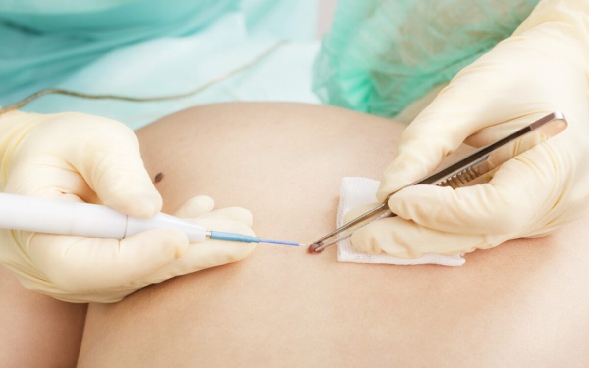 Procedimiento de cirugía dermatológica en DermoGarda